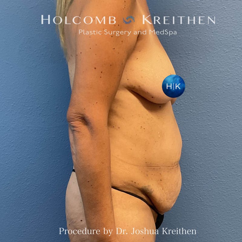 Tummy Tuck Before & After Gallery - Patient 123488 - Image 5