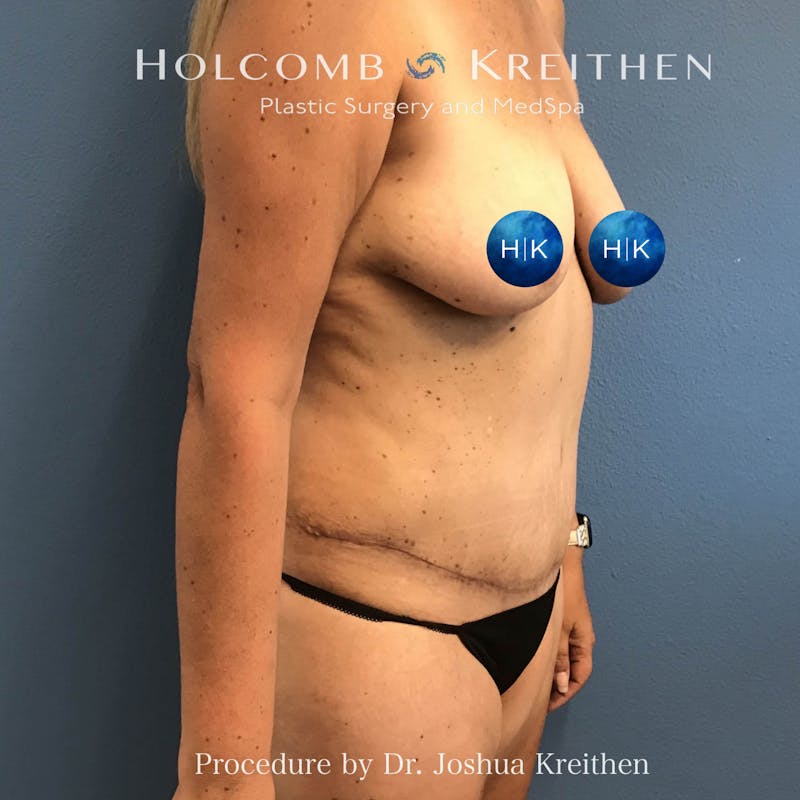 Tummy Tuck Before & After Gallery - Patient 123488 - Image 4