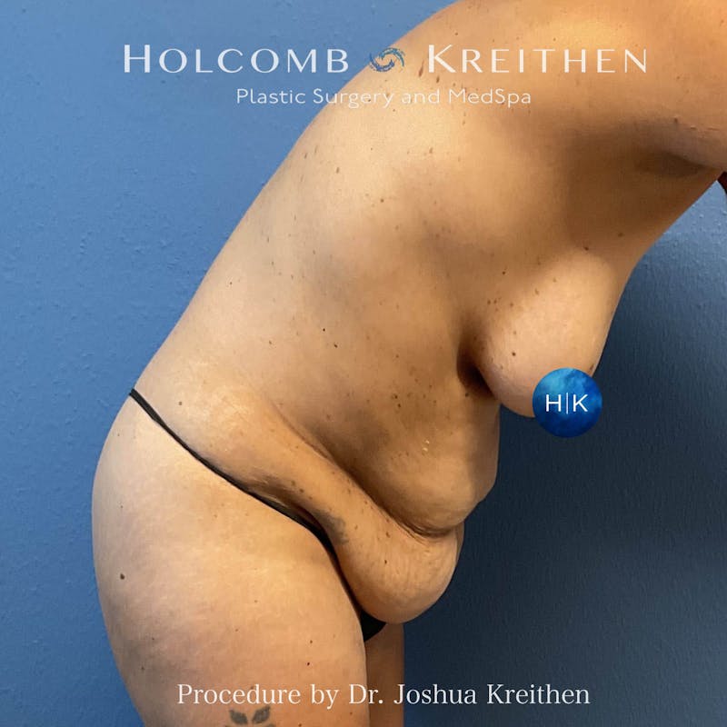 Tummy Tuck Before & After Gallery - Patient 123488 - Image 7