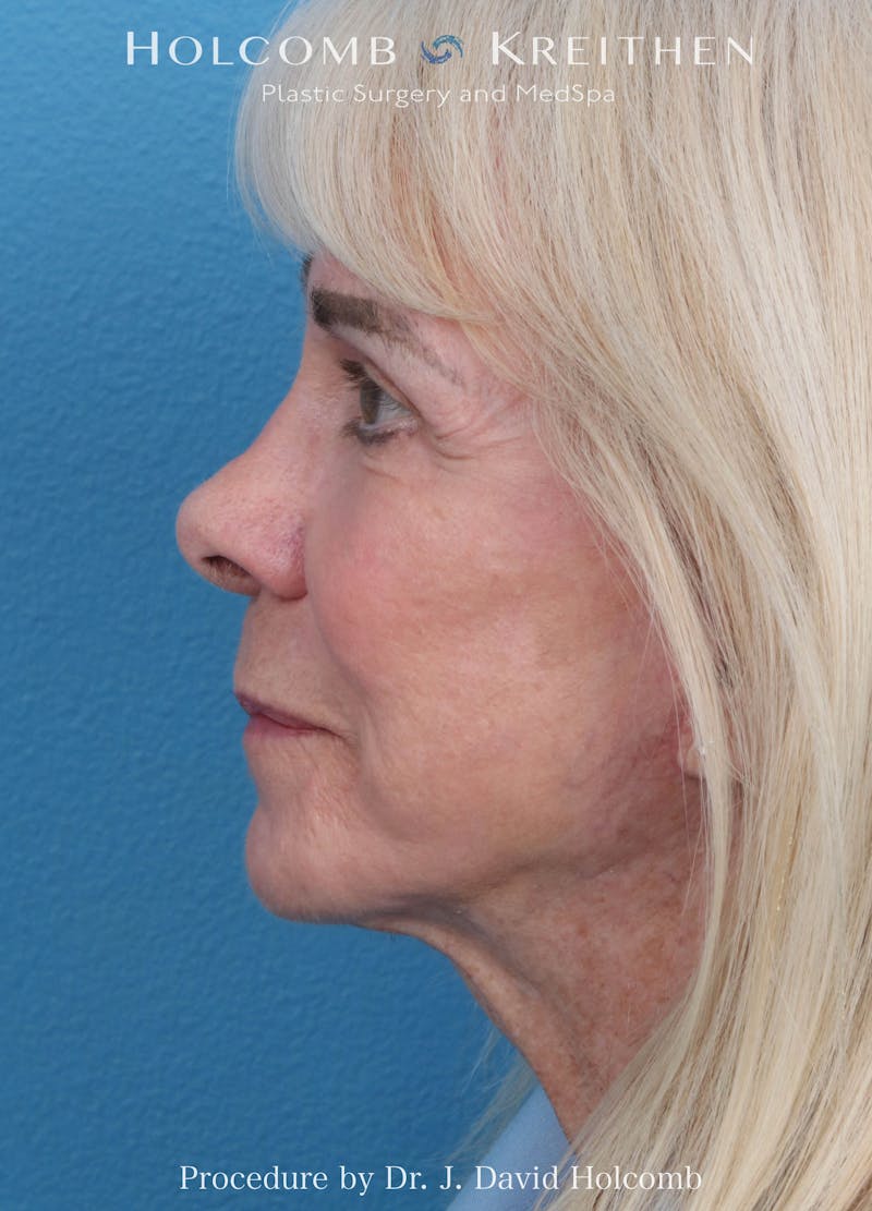 eCO2 Fractional Laser Before & After Gallery - Patient 291463 - Image 10