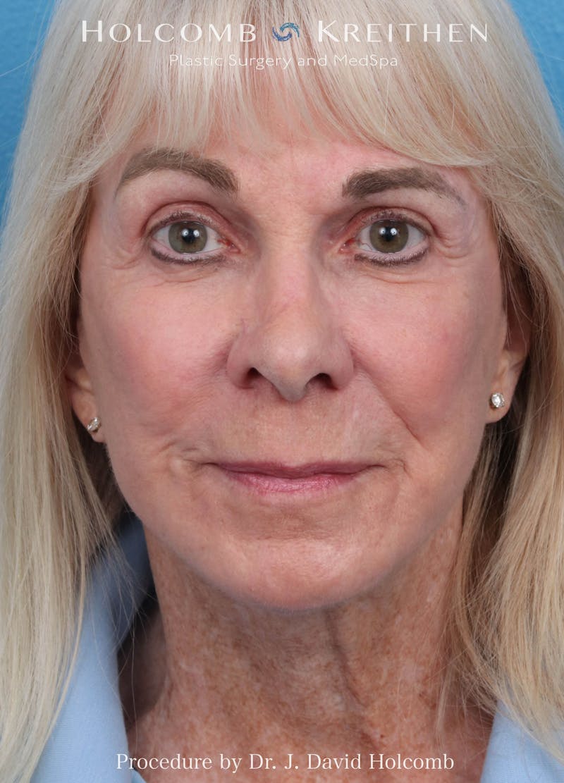 eCO2 Fractional Laser Before & After Gallery - Patient 291463 - Image 2