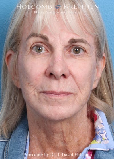 eCO2 Fractional Laser Before & After Gallery - Patient 291463 - Image 1