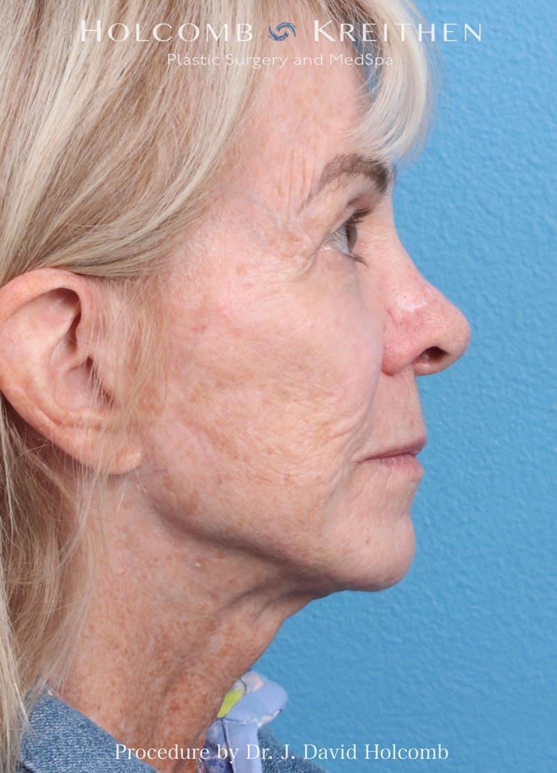 eCO2 Fractional Laser Before & After Gallery - Patient 291463 - Image 5