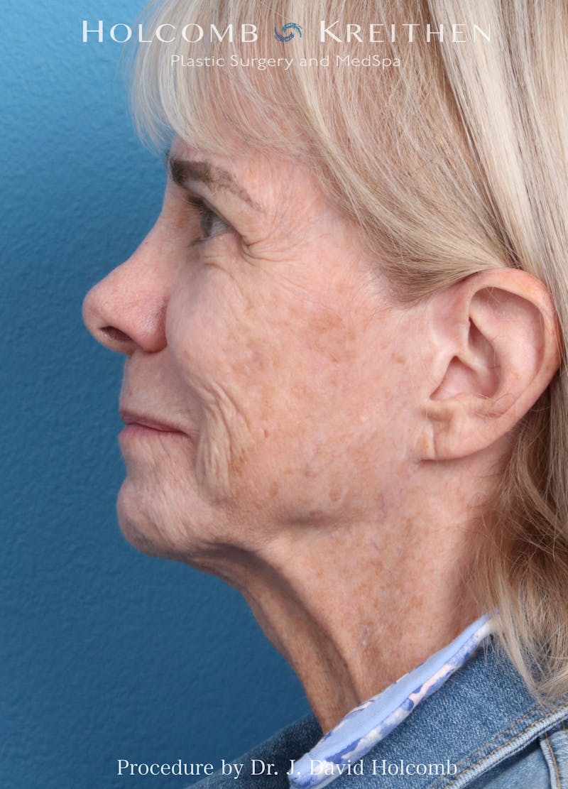 eCO2 Fractional Laser Before & After Gallery - Patient 291463 - Image 9
