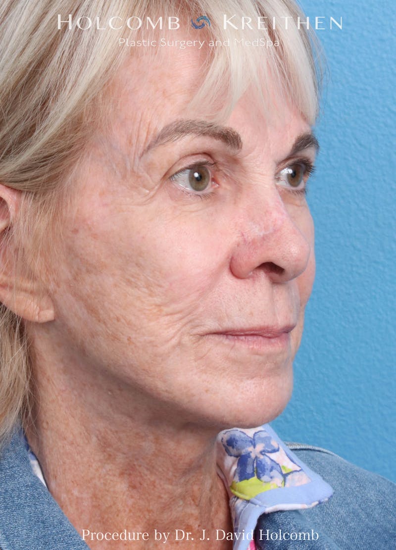 eCO2 Fractional Laser Before & After Gallery - Patient 291463 - Image 3