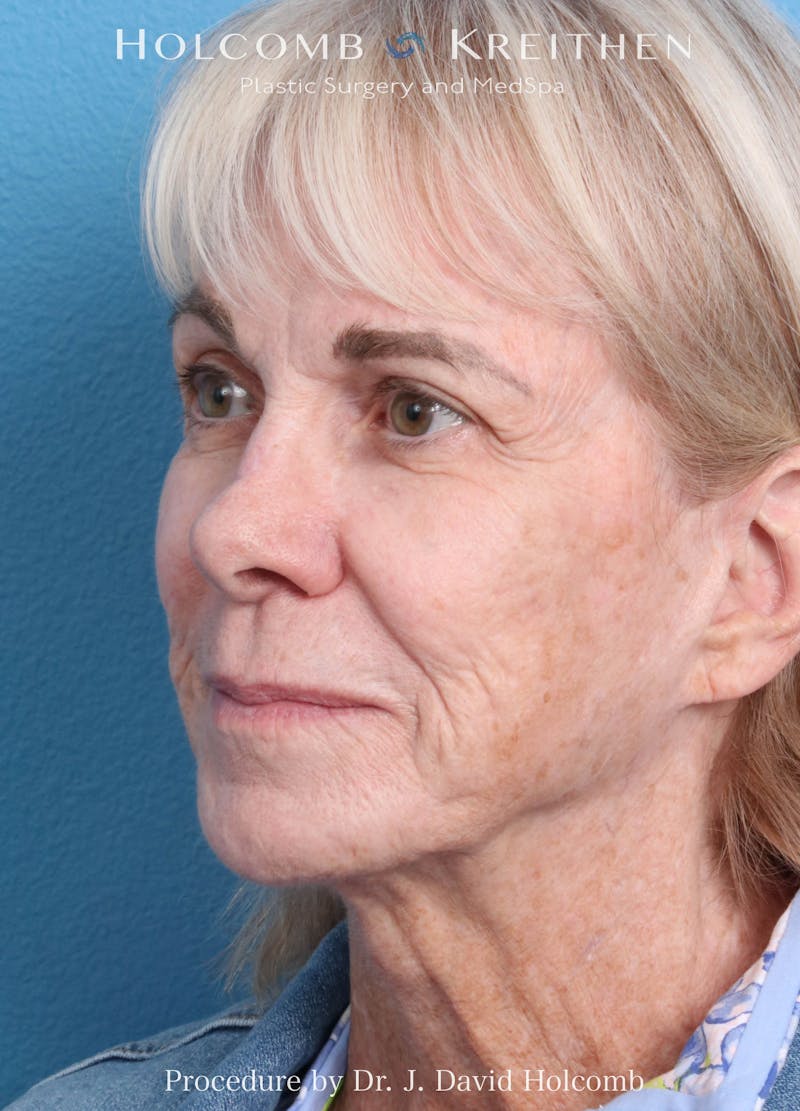 eCO2 Fractional Laser Before & After Gallery - Patient 291463 - Image 7