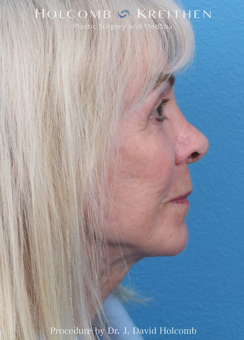 eCO2 Fractional Laser Before & After Gallery - Patient 291463 - Image 6