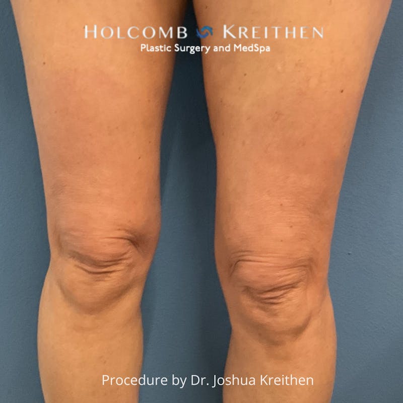 Morpheus  Before & After Gallery - Patient 365309 - Image 4