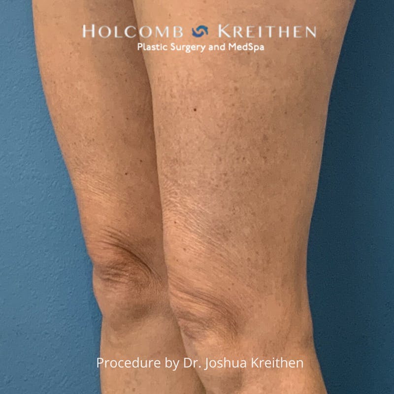 Morpheus  Before & After Gallery - Patient 365309 - Image 1