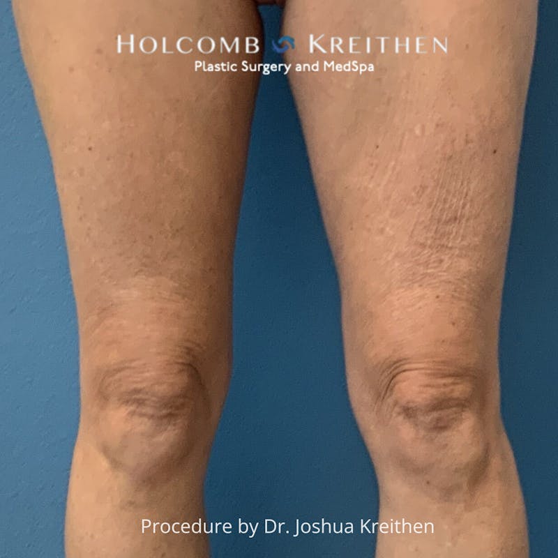 Morpheus  Before & After Gallery - Patient 365309 - Image 3