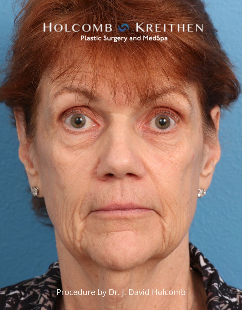 Facelift Before & After Gallery - Patient 206590 - Image 1