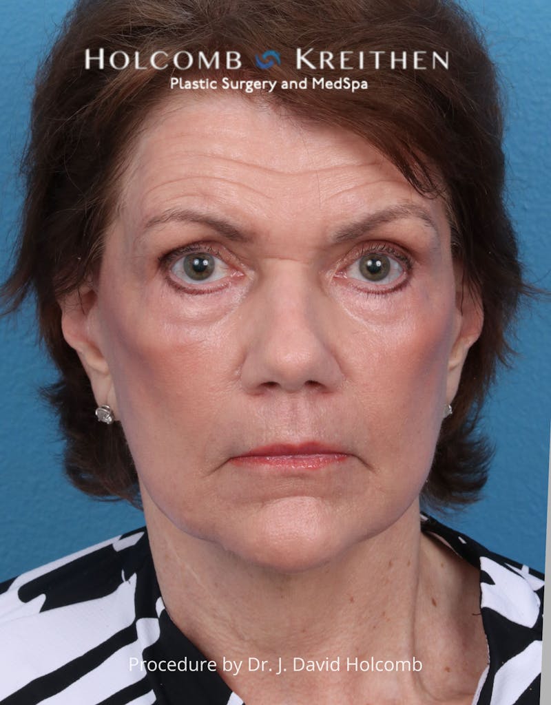 Facelift Before & After Gallery - Patient 206590 - Image 2
