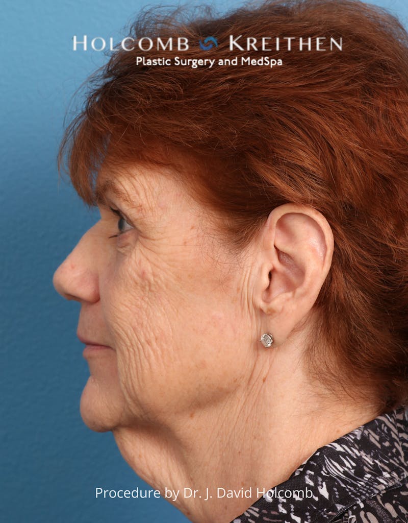 Facelift Before & After Gallery - Patient 206590 - Image 7