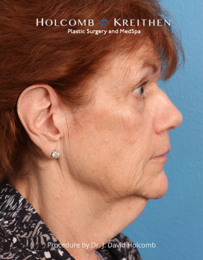 Facelift Before & After Gallery - Patient 206590 - Image 5