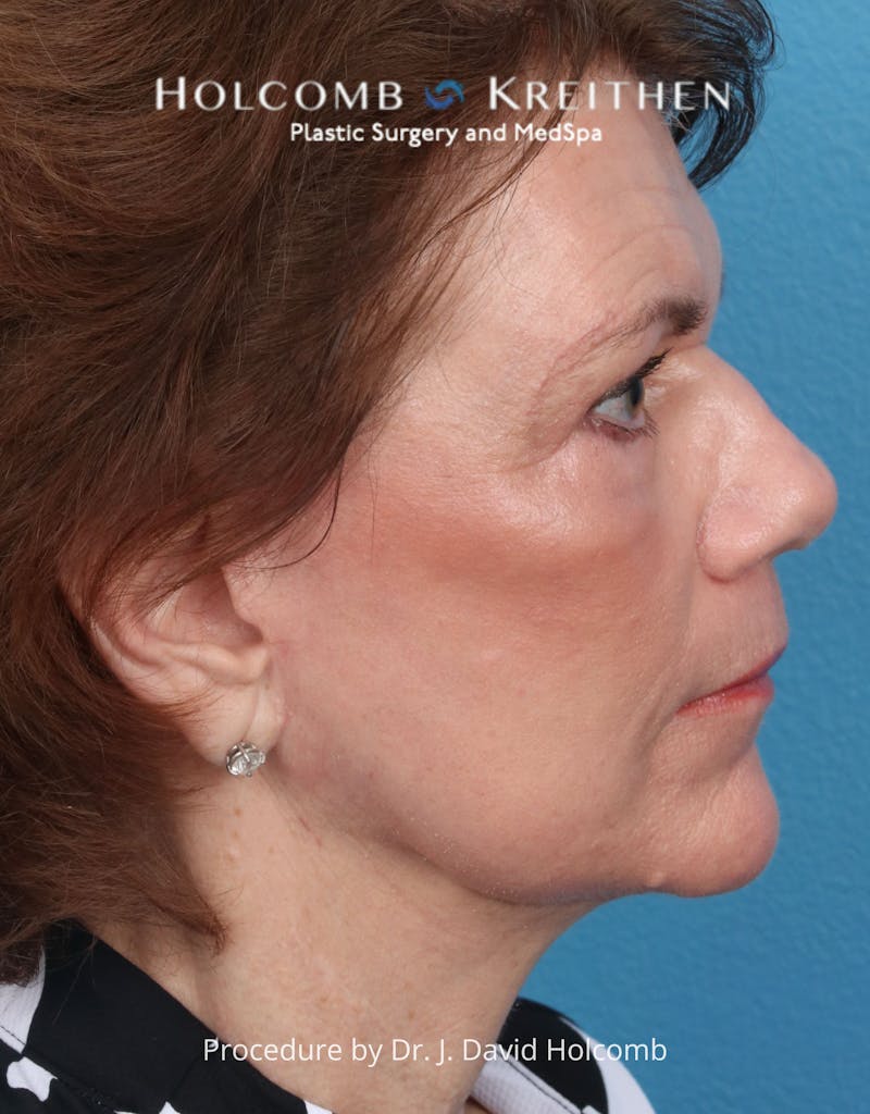Facelift Before & After Gallery - Patient 206590 - Image 6