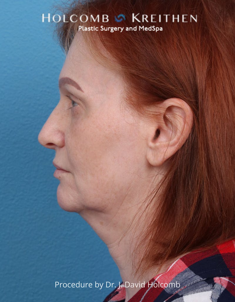 Facelift Before & After Gallery - Patient 235722 - Image 9