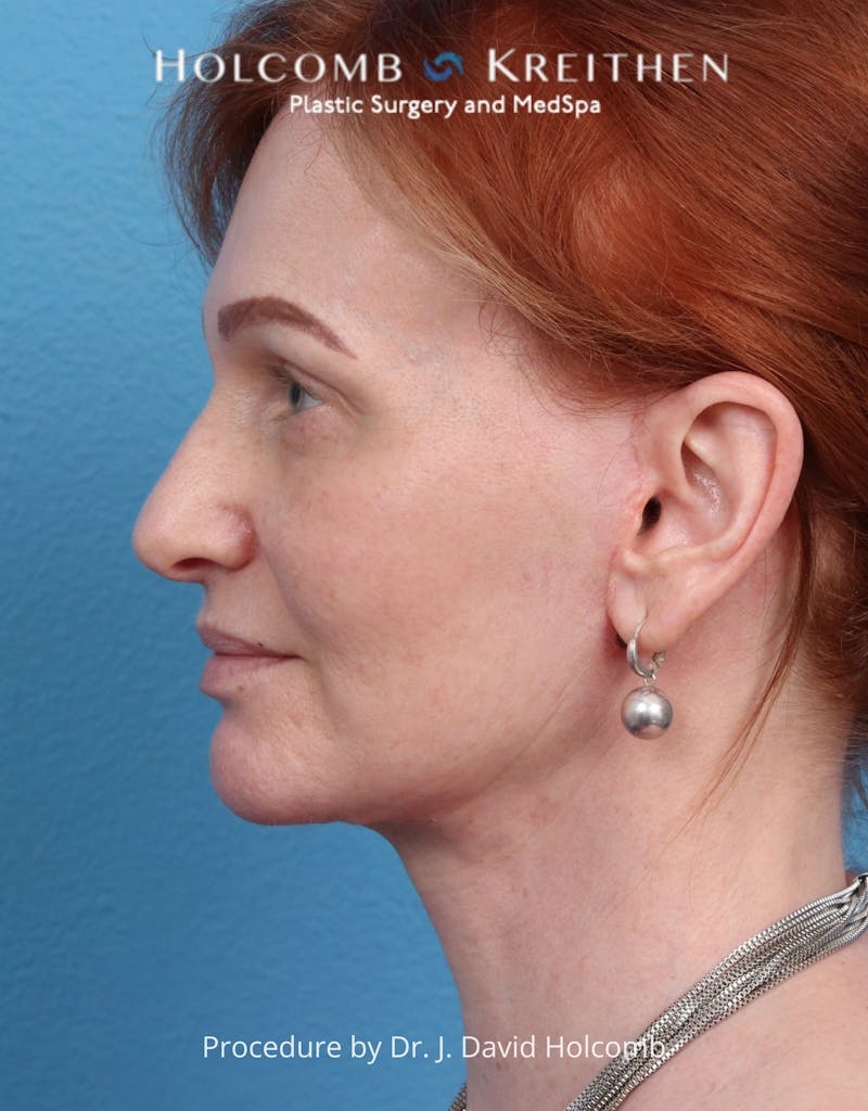 Facelift Before & After Gallery - Patient 235722 - Image 10
