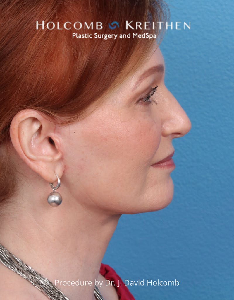 Facelift Before & After Gallery - Patient 235722 - Image 6