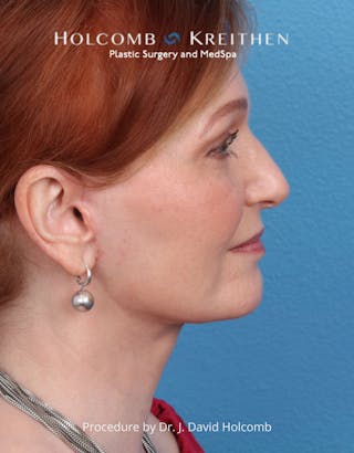 Facelift Before & After Gallery - Patient 235722 - Image 6