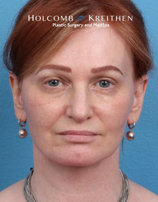 Facelift Before & After Gallery - Patient 235722 - Image 4