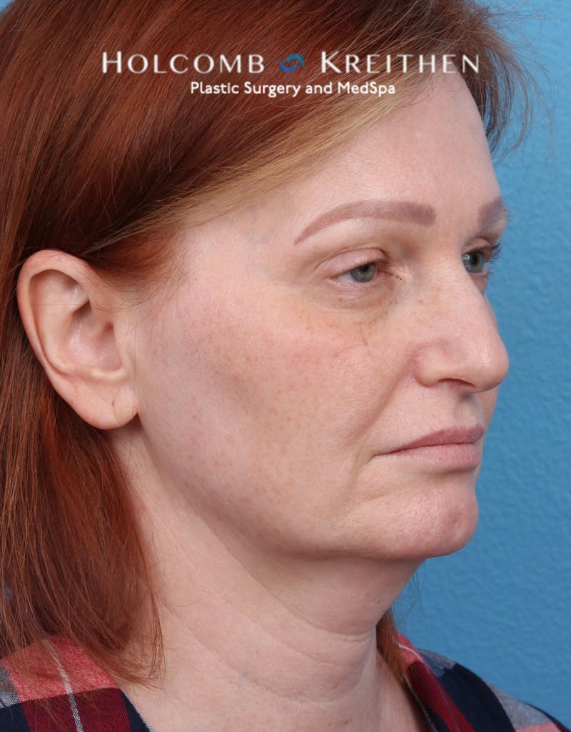 Facelift Before & After Gallery - Patient 235722 - Image 3