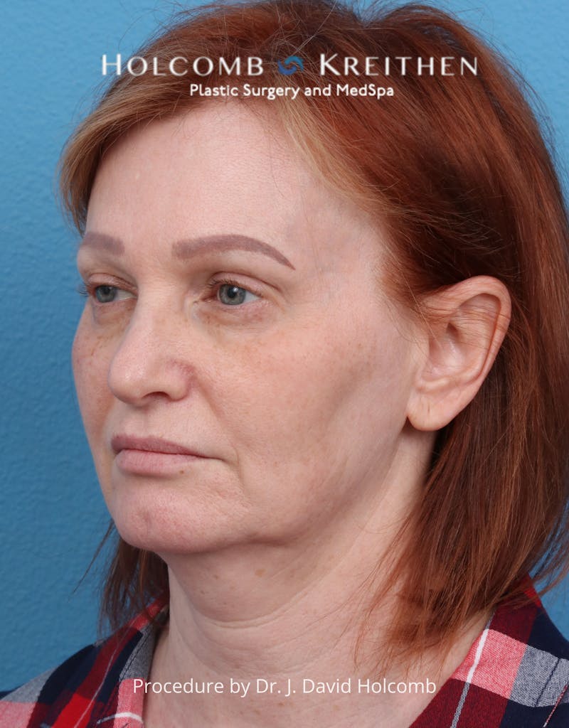 Facelift Before & After Gallery - Patient 235722 - Image 7