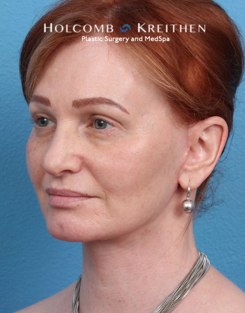 Facelift Before & After Gallery - Patient 235722 - Image 8