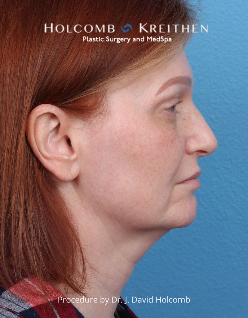 Facelift Before & After Gallery - Patient 235722 - Image 5