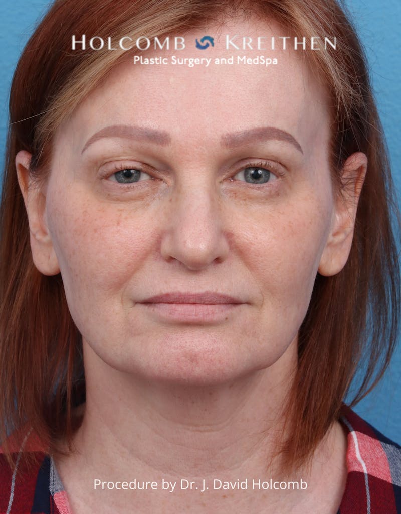 Facelift Before & After Gallery - Patient 235722 - Image 1