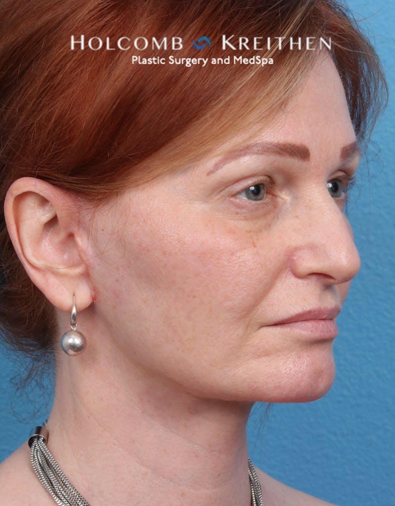 Facelift Before & After Gallery - Patient 235722 - Image 4