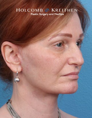 Facelift Before & After Gallery - Patient 235722 - Image 2