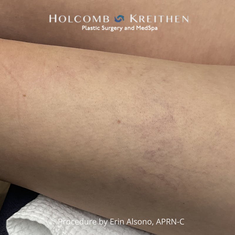 Excel V Before & After Gallery - Patient 400056 - Image 1