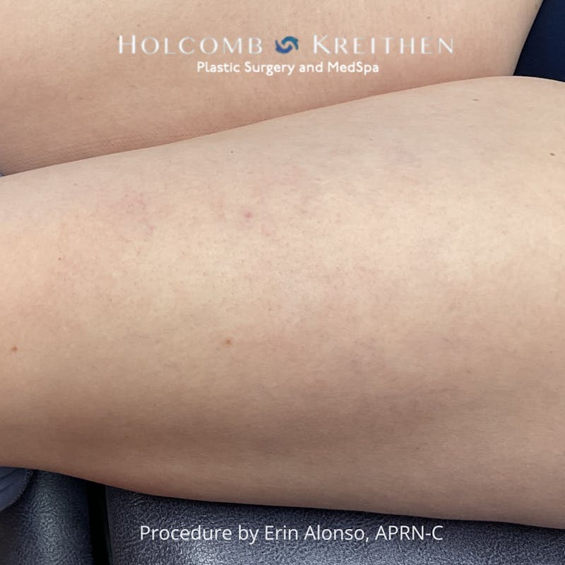 Excel V Before & After Gallery - Patient 400056 - Image 2