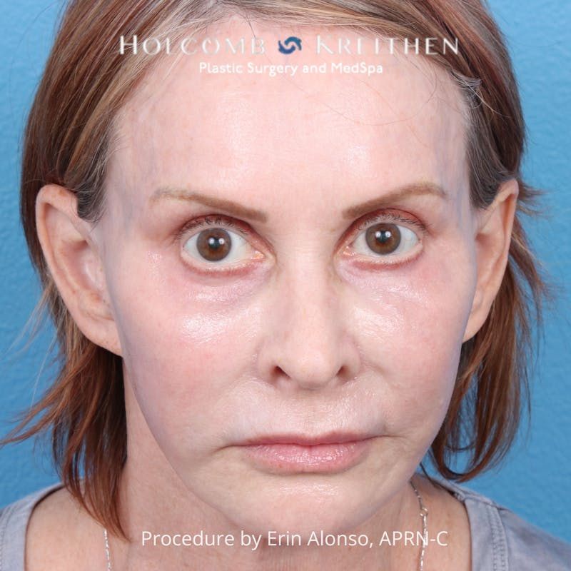 Ultraclear Before & After Gallery - Patient 344380 - Image 2