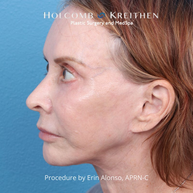 Ultraclear Before & After Gallery - Patient 344380 - Image 4