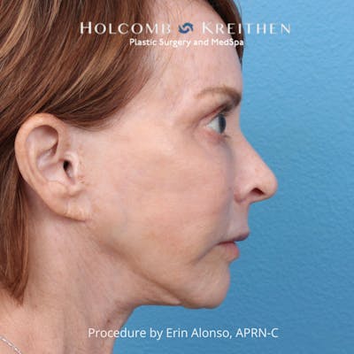 Ultraclear Before & After Gallery - Patient 344380 - Image 1