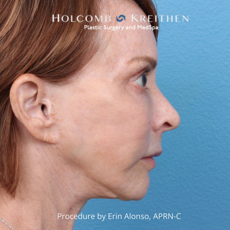 Ultraclear Before & After Gallery - Patient 344380 - Image 5