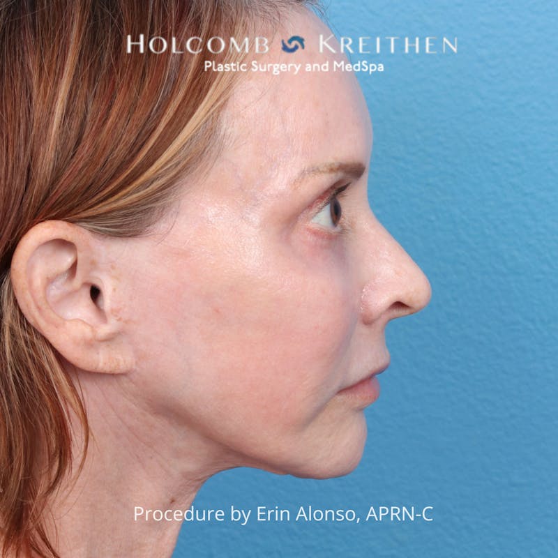 Ultraclear Before & After Gallery - Patient 344380 - Image 6