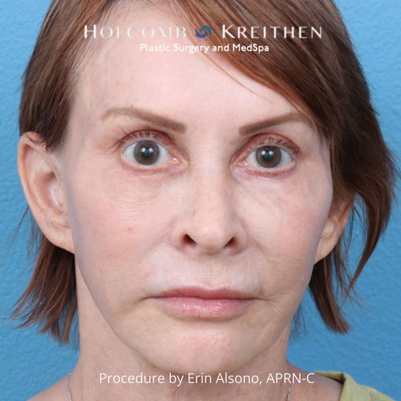 Ultraclear Before & After Gallery - Patient 344380 - Image 1