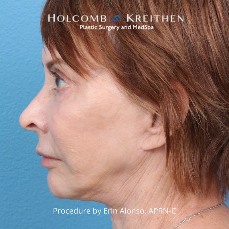 Ultraclear Before & After Gallery - Patient 344380 - Image 3