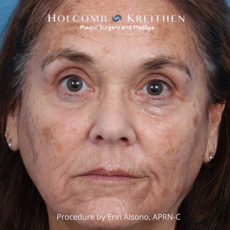 TRL Laser Skin Resurfacing Before & After Gallery - Patient 394056 - Image 1