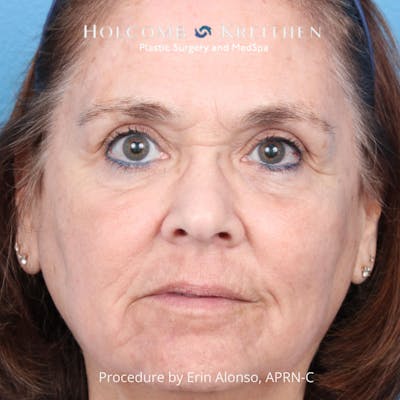 TRL Laser Skin Resurfacing Before & After Gallery - Patient 394056 - Image 2