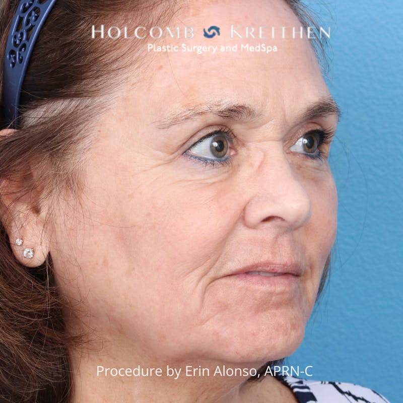TRL Laser Skin Resurfacing Before & After Gallery - Patient 394056 - Image 6