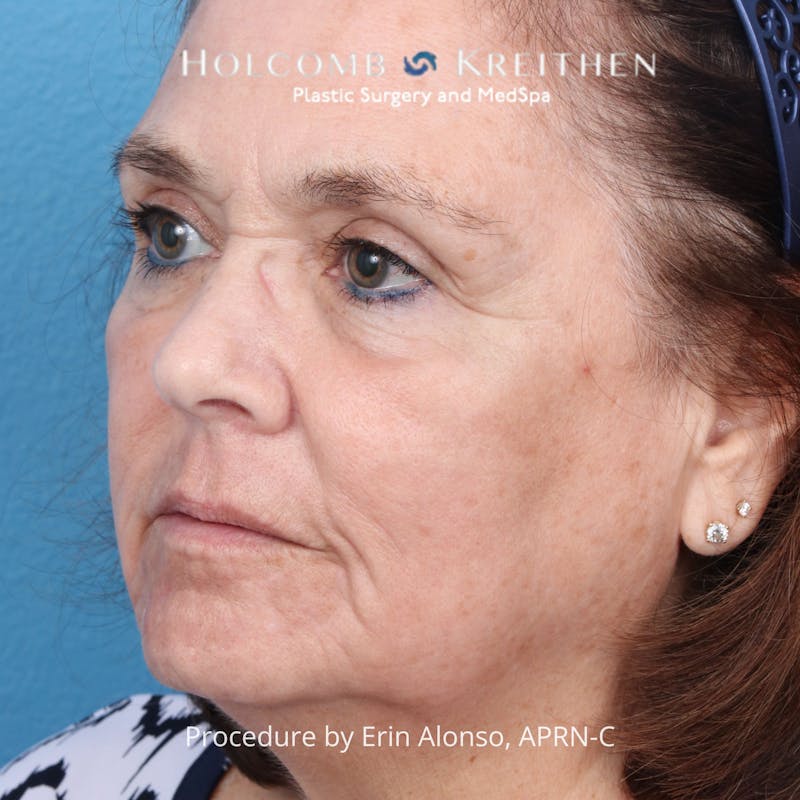 TRL Laser Skin Resurfacing Before & After Gallery - Patient 394056 - Image 4