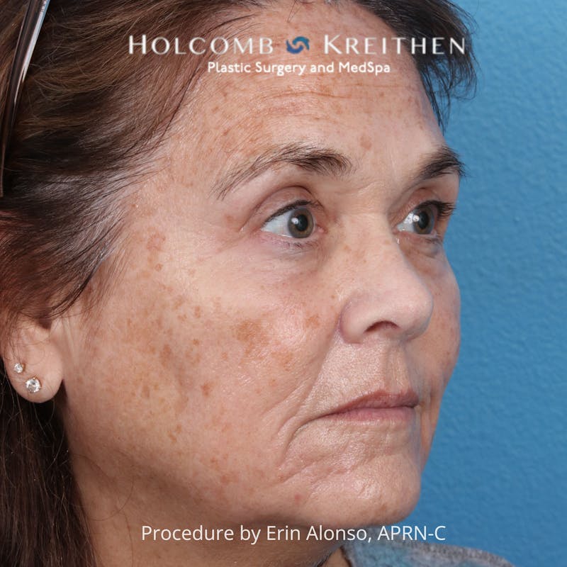 TRL Laser Skin Resurfacing Before & After Gallery - Patient 394056 - Image 5
