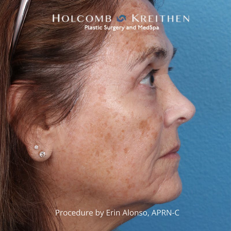 TRL Laser Skin Resurfacing Before & After Gallery - Patient 394056 - Image 7