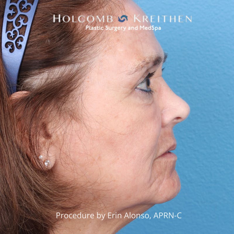 TRL Laser Skin Resurfacing Before & After Gallery - Patient 394056 - Image 8