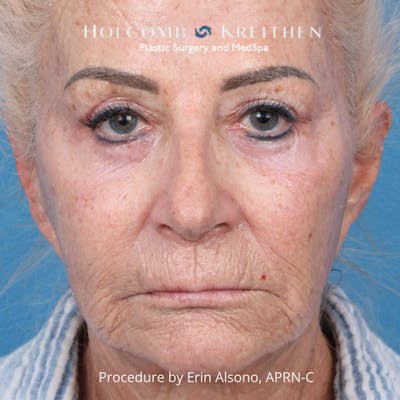 TRL Laser Skin Resurfacing Before & After Gallery - Patient 118342 - Image 1