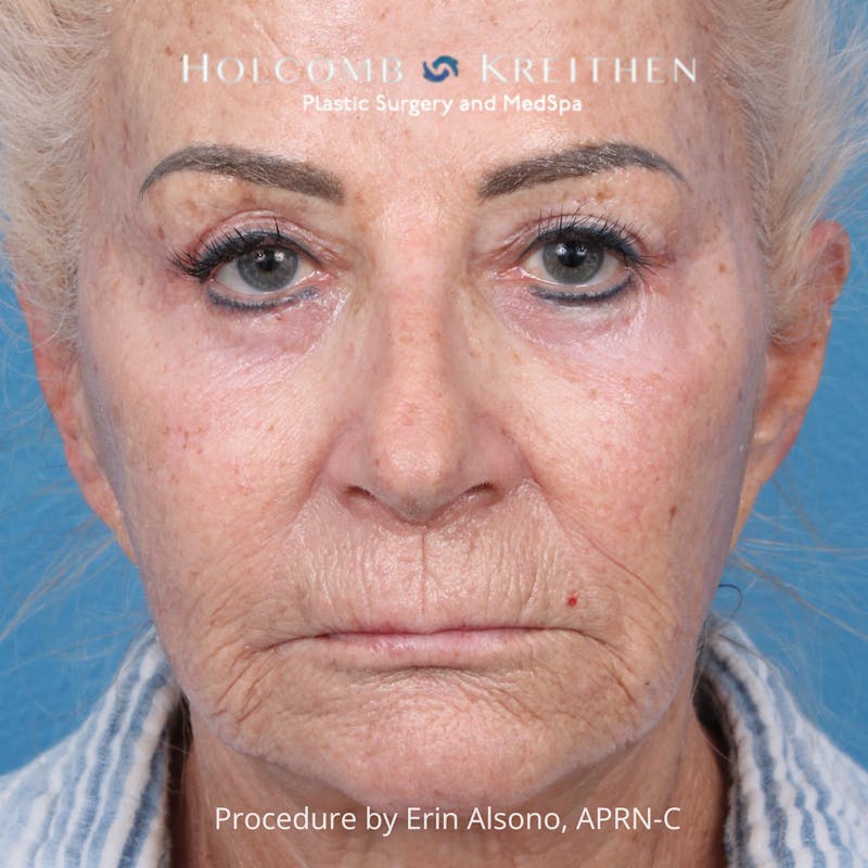 TRL Laser Skin Resurfacing Before & After Gallery - Patient 118342 - Image 1