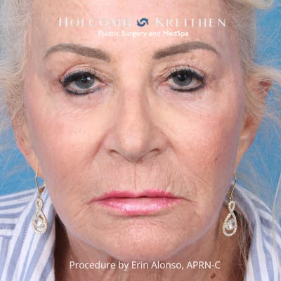TRL Laser Skin Resurfacing Before & After Gallery - Patient 118342 - Image 2